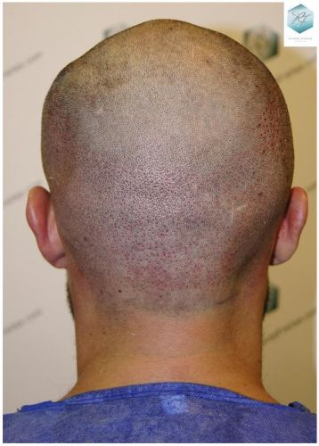 Injerto Capilar Técnica FUE 1870 Grafts (4013 Pelos) 12 TRASPLANTE DE PELO