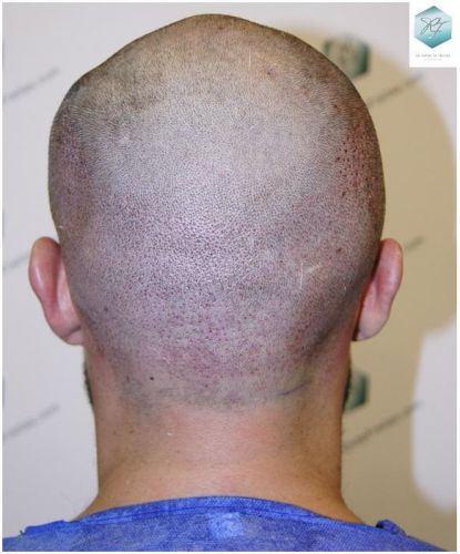 Injerto Capilar Técnica FUE 1870 Grafts (4013 Pelos) 11 TRASPLANTE DE PELO