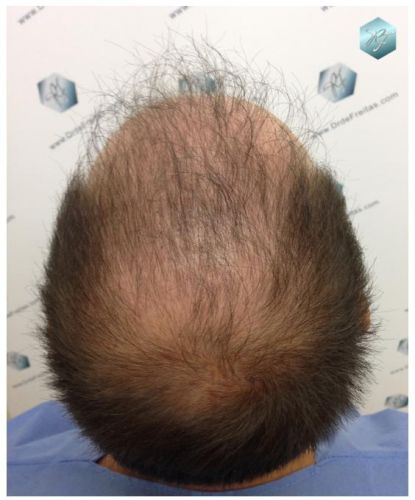 TRASPLANTE DE PELO