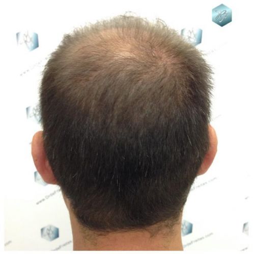 TRASPLANTE DE PELO