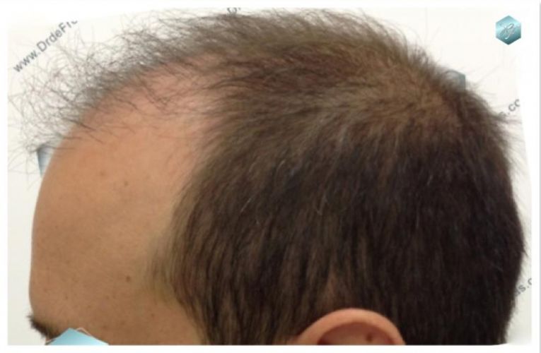 TRASPLANTE DE PELO