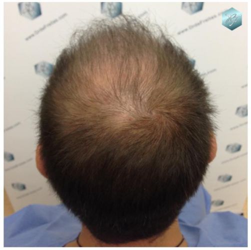 TRASPLANTE DE PELO