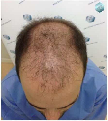 TRASPLANTE DE PELO