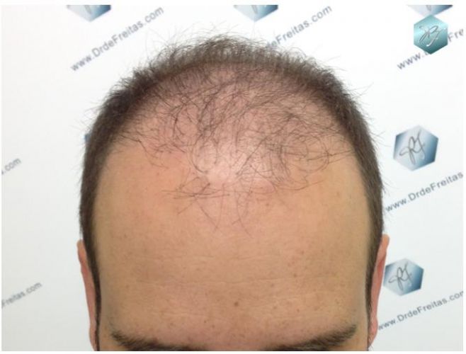 TRASPLANTE DE PELO