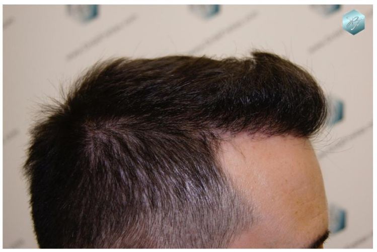 TRASPLANTE DE PELO