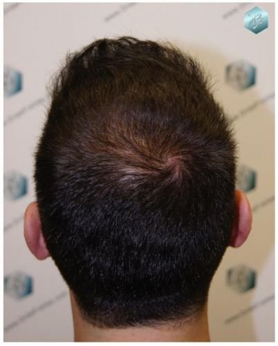 TRASPLANTE DE PELO