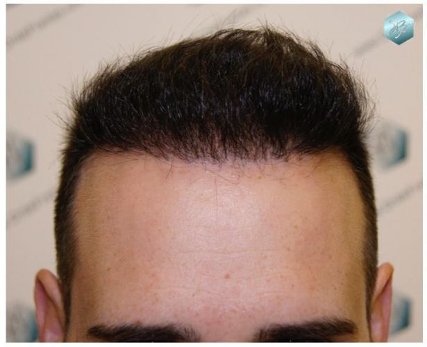 TRASPLANTE DE PELO
