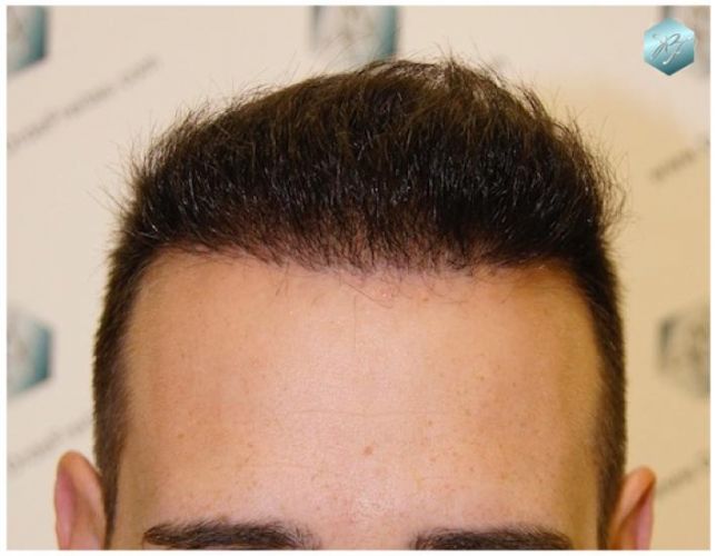TRASPLANTE DE PELO