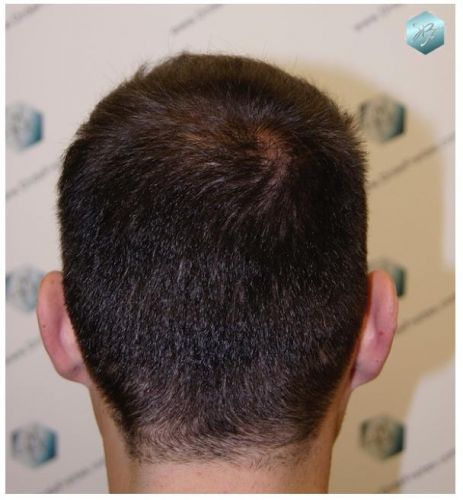 TRASPLANTE DE PELO