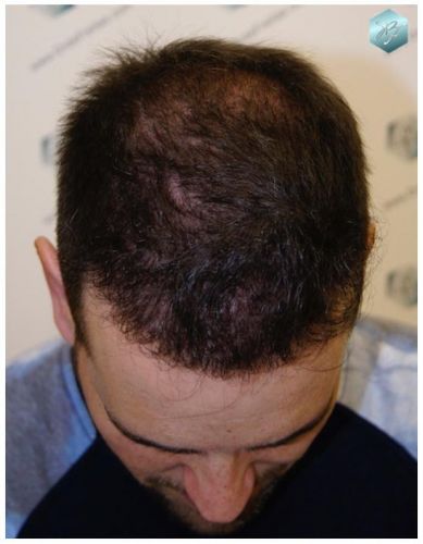 TRASPLANTE DE PELO