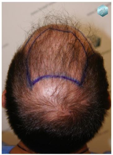 TRASPLANTE DE PELO