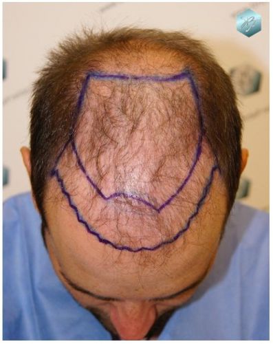 TRASPLANTE DE PELO