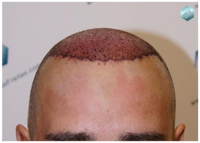 TRASPLANTE DE PELO