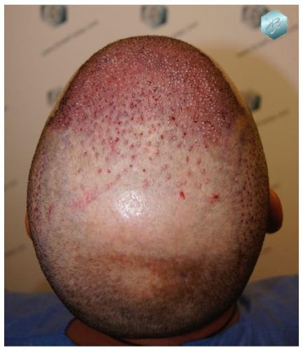 TRASPLANTE DE PELO