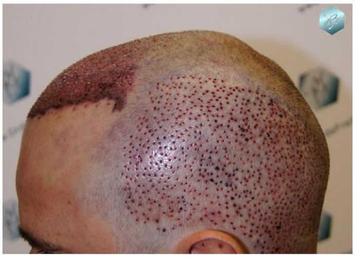 TRASPLANTE DE PELO