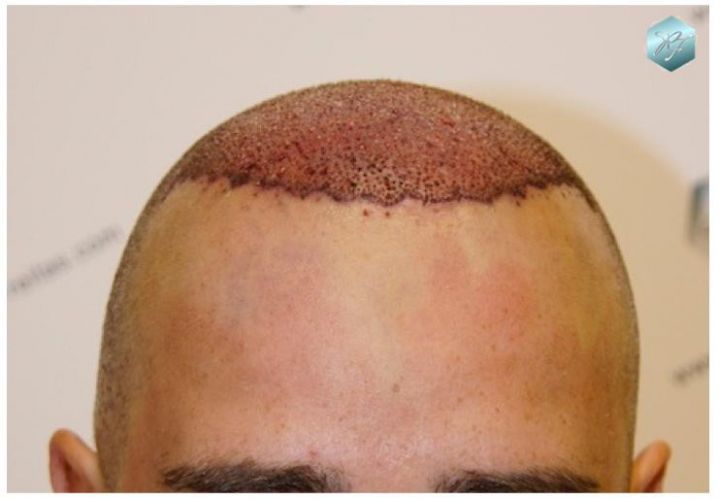 TRASPLANTE DE PELO