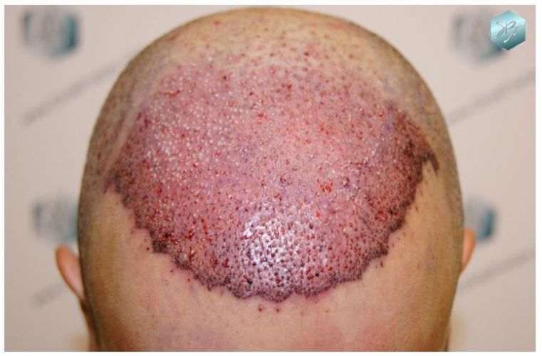 TRASPLANTE DE PELO