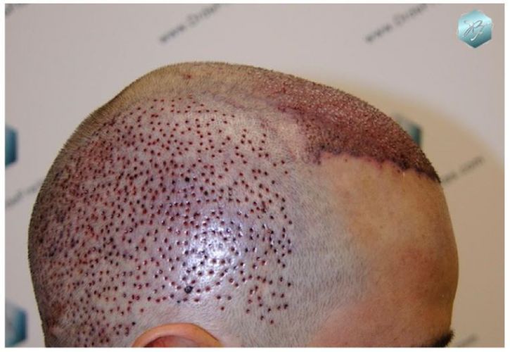 TRASPLANTE DE PELO