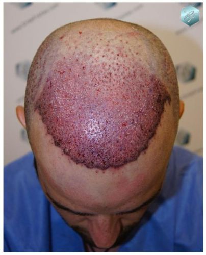 TRASPLANTE DE PELO
