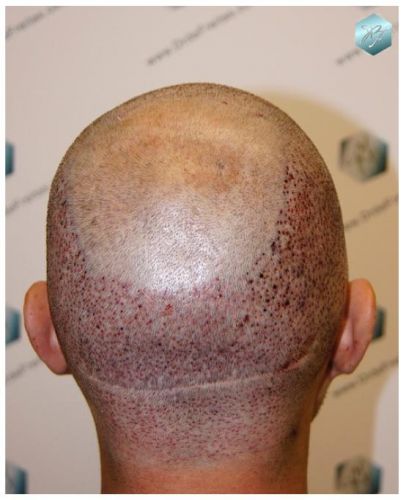 TRASPLANTE DE PELO