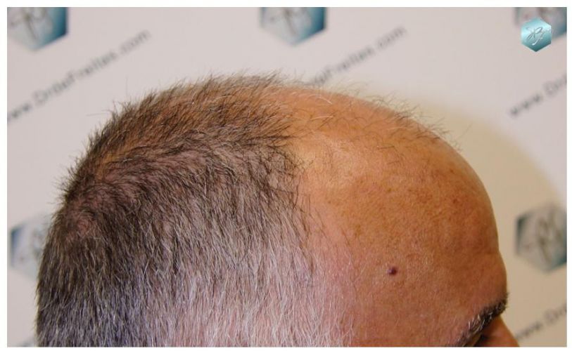 TRASPLANTE DE PELO