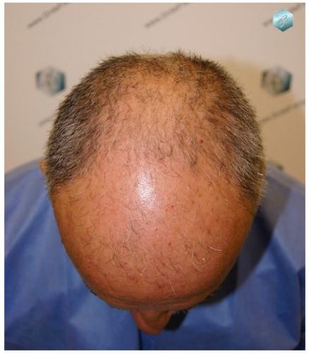TRASPLANTE DE PELO