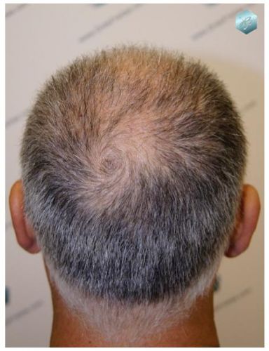 TRASPLANTE DE PELO