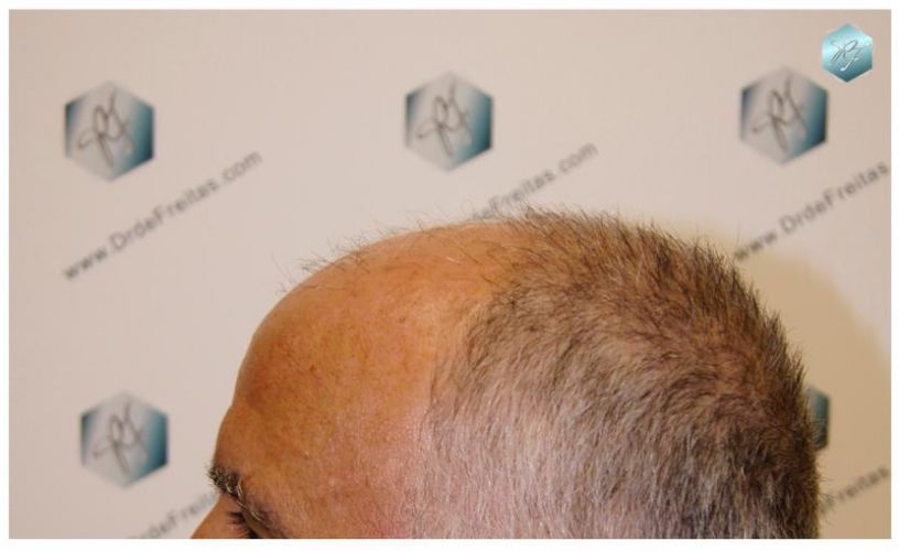 TRASPLANTE DE PELO