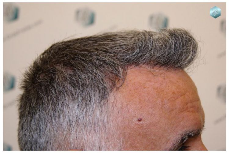TRASPLANTE DE PELO