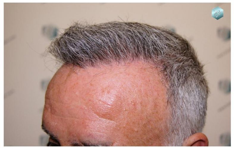 TRASPLANTE DE PELO