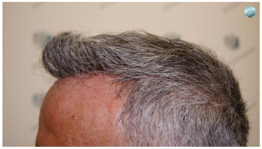 TRASPLANTE DE PELO
