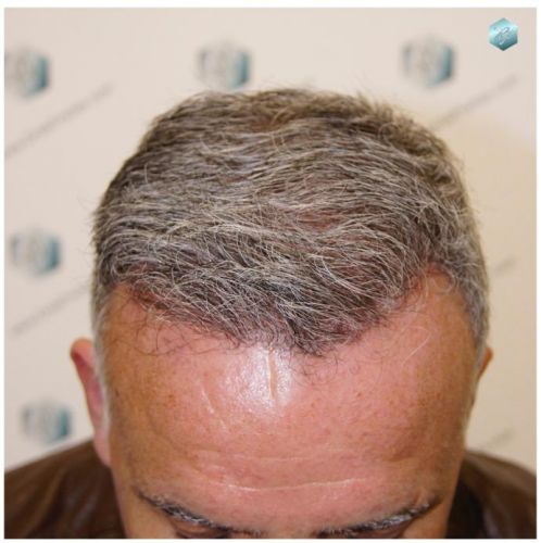 TRASPLANTE DE PELO