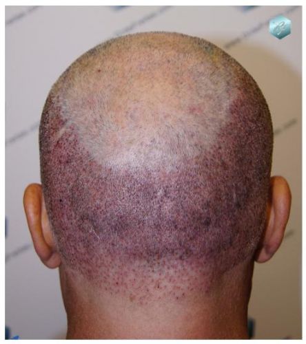 TRASPLANTE DE PELO