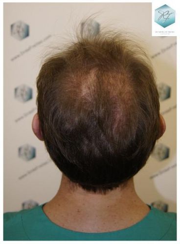 TRASPLANTE DE PELO