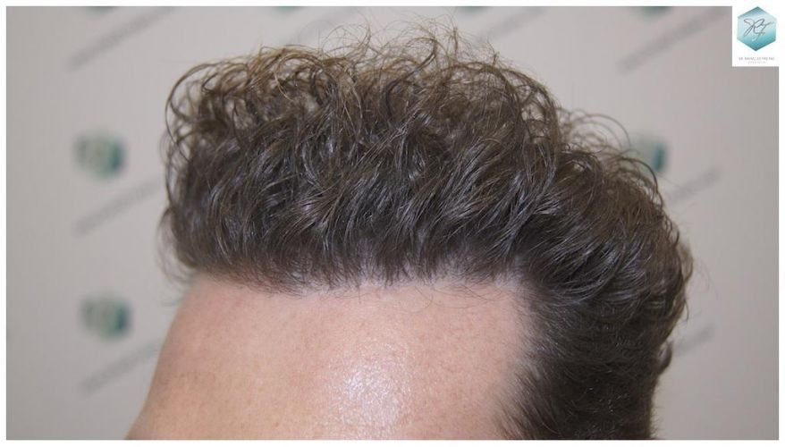 TRASPLANTE DE PELO