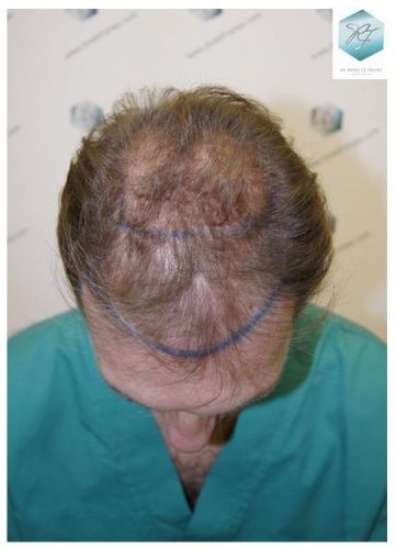 TRASPLANTE DE PELO