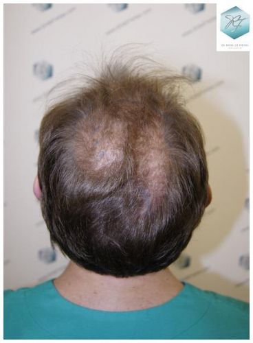 TRASPLANTE DE PELO