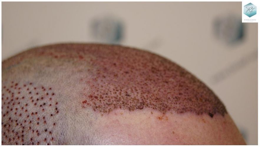 TRASPLANTE DE PELO