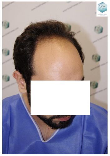 Injerto Capilar Técnica FUE 3681 Grafts (8585 Pelos) 4 TECNICA FUE