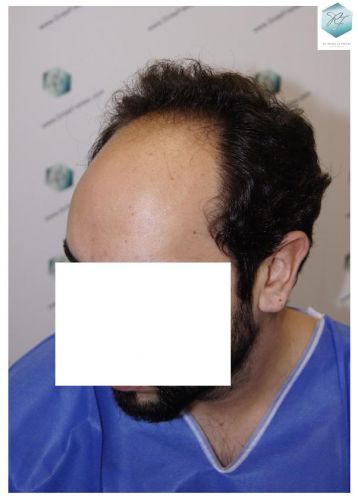 Injerto Capilar Técnica FUE 3681 Grafts (8585 Pelos) 6 TECNICA FUE