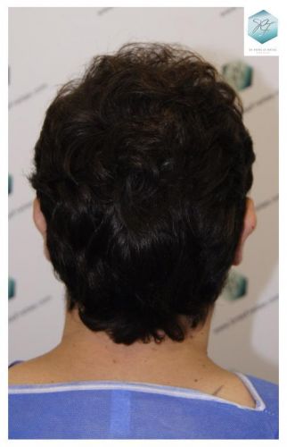Injerto Capilar Técnica FUE 3681 Grafts (8585 Pelos) 9 TECNICA FUE