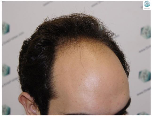 Injerto Capilar Técnica FUE 3681 Grafts (8585 Pelos) 3 TECNICA FUE