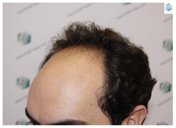 Injerto Capilar Técnica FUE 3681 Grafts (8585 Pelos) 5 TECNICA FUE