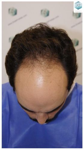 Injerto Capilar Técnica FUE 3681 Grafts (8585 Pelos) 1 TECNICA FUE