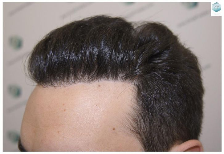 Injerto Capilar Técnica FUE 3681 Grafts (8585 Pelos) 38 TECNICA FUE
