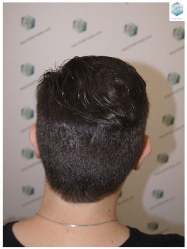Injerto Capilar Técnica FUE 3681 Grafts (8585 Pelos) 39 TECNICA FUE