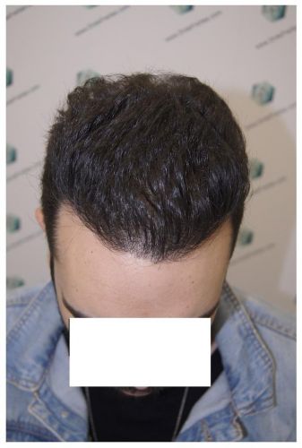 Injerto Capilar Técnica FUE 3681 Grafts (8585 Pelos) 31 TECNICA FUE