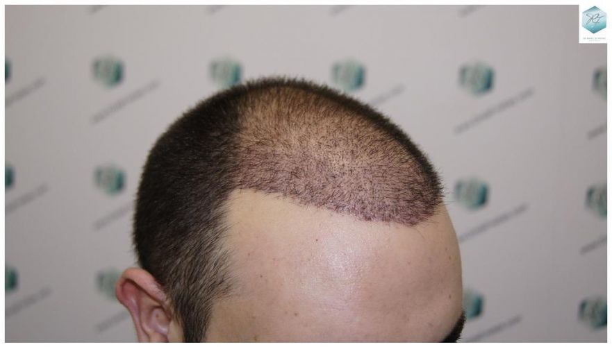 Injerto Capilar Técnica FUE 3681 Grafts (8585 Pelos) 24 TECNICA FUE