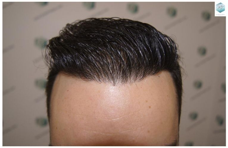 Injerto Capilar Técnica FUE 3681 Grafts (8585 Pelos) 28 TECNICA FUE