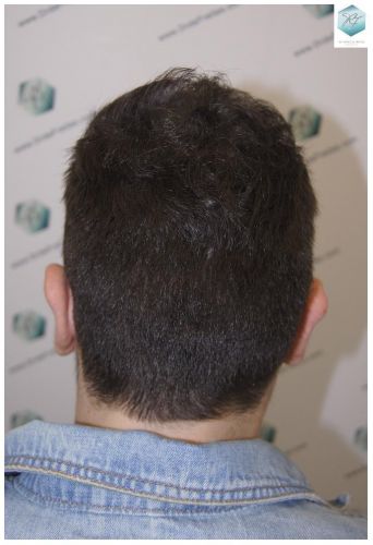 Injerto Capilar Técnica FUE 3681 Grafts (8585 Pelos) 40 TECNICA FUE